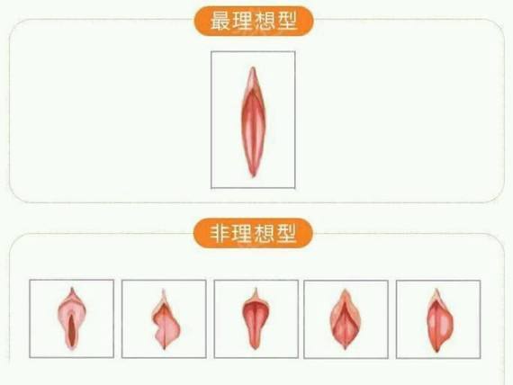 用嘴帮助用嘴来丰胸——一个荒谬且危险的美容误区-第3张图片